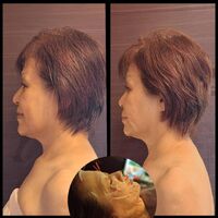 画像5196：施術事例